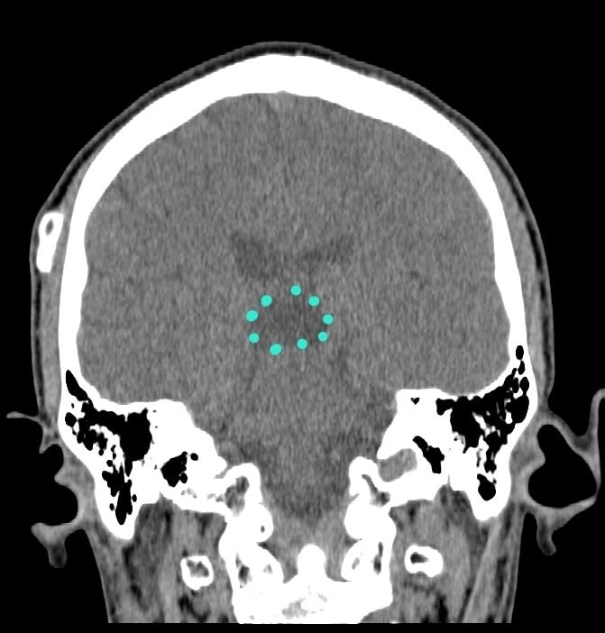 reseccion de tumor pineal