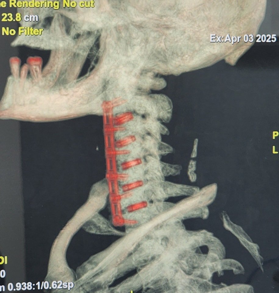 cirugia de hernias cervicales despues